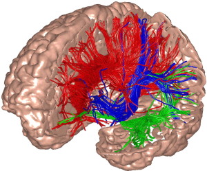 Diffusion Tensor Imaging for hydrocephalus