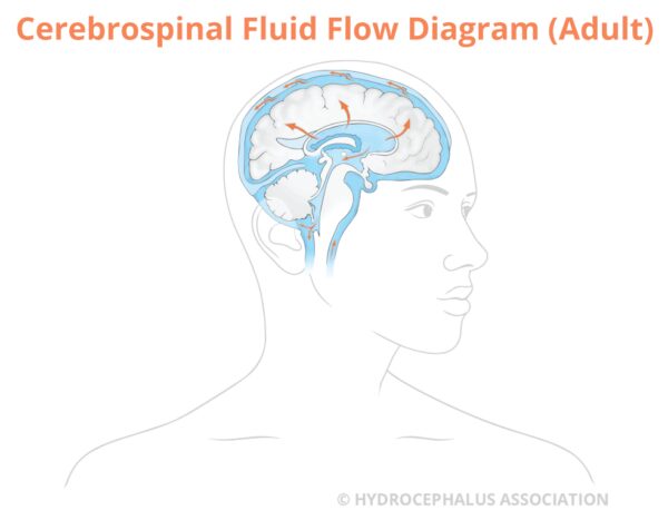 hydrocephalus, csf, adult