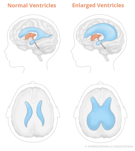 HA Ventricles EnlargedNormal web Label