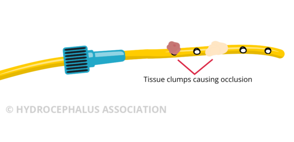 Occluded catheter